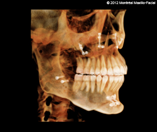 Marie-Hélène Cyr - Scan 3D (profil droit à 45 degrés) après des traitements d'orthodontie et des chirurgies orthognatiques (13 février 2012)